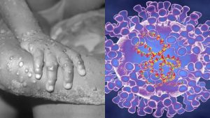 Brasileiro é primeiro infectado com varíola de macacos na Alemanha